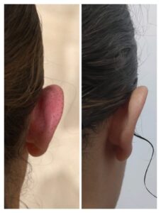Otoplastia